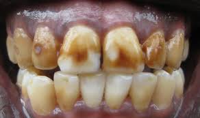 E11 dENTAL fLUOROSIS (4)